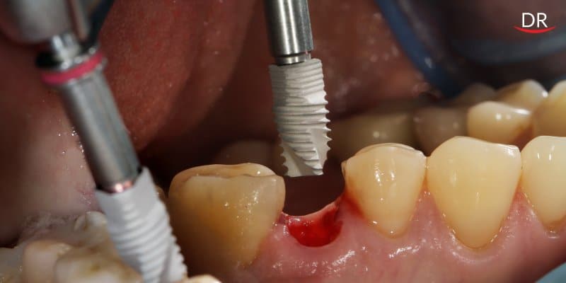 Managing an atrophic mandible with short implants