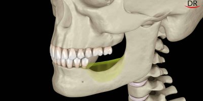 Residual Ridge Resorption: The Unstoppable Phenomenon