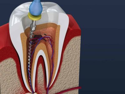 Overcoming Endodontic Failure