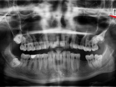 The Journey of Panoramic Radiography - A Review (Part I)