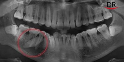 Giant sialolith as big as an adult tooth recently discovered from a patient's mouth.