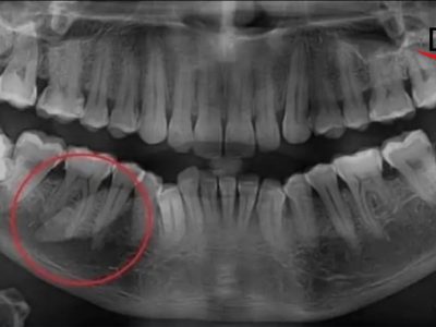 Giant sialolith as big as an adult tooth recently discovered from a patient's mouth.