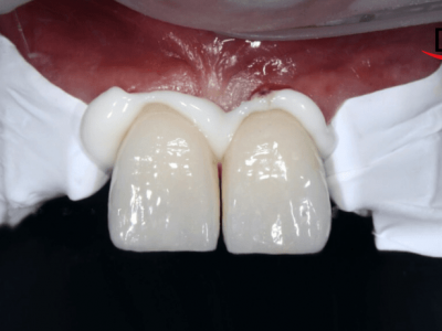 Your Go-To Guide For Cementation Of All Types Of Prosthesis (Part 1)