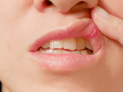 Oral Lesions may be a COVID-19 Symptom, Study Suggests