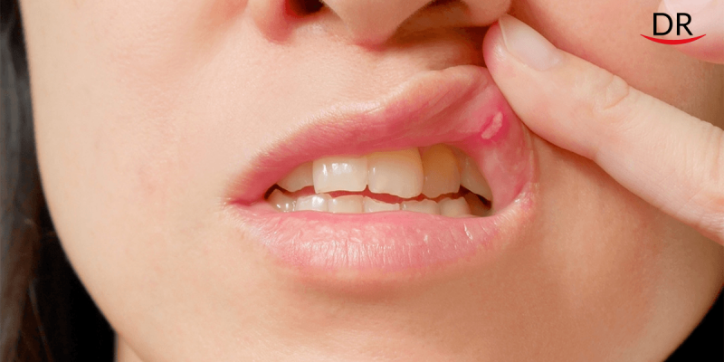 Oral Lesions may be a COVID-19 Symptom, Study Suggests