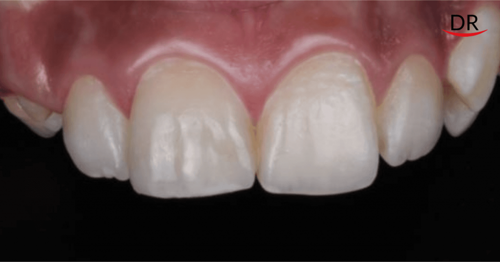 Composite Restorations for Esthetic Correction of a Single Anterior Tooth
