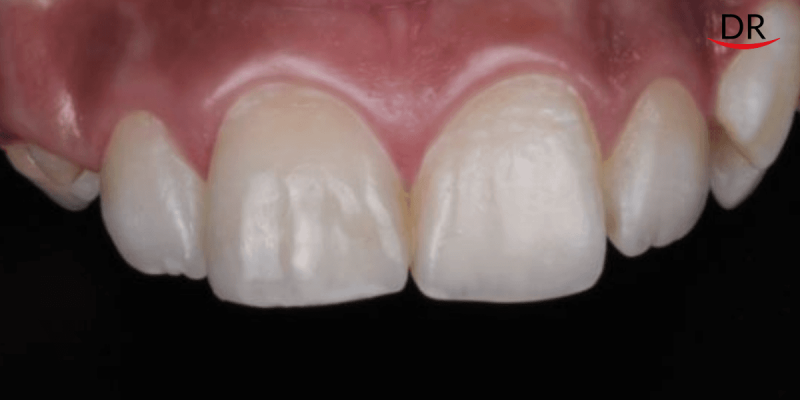 Composite Restorations for Aesthetic Correction of a Single Anterior Tooth
