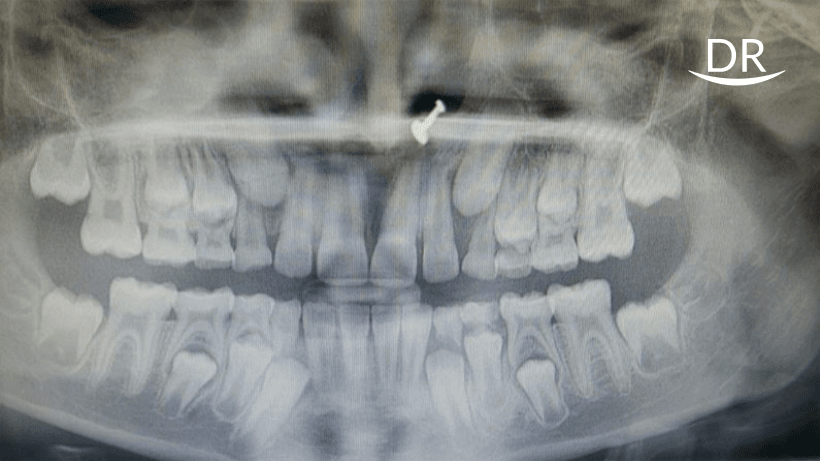 Management of Pyogenic Granuloma: A Case Report