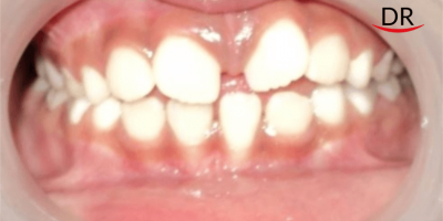 Management of Non-Vital Immature Teeth: A Case Report