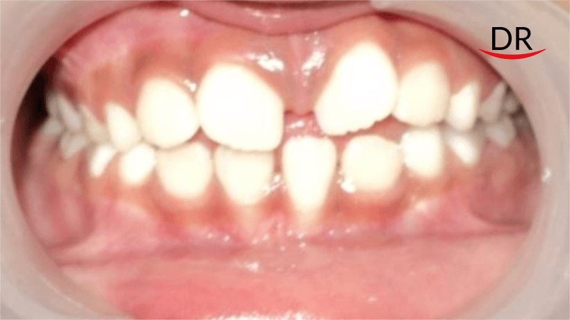 Management of Non-Vital Immature Teeth: A Case Report