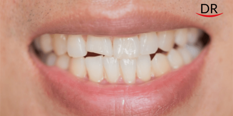 Reports of Cracked Teeth Uptick Amid COVID19