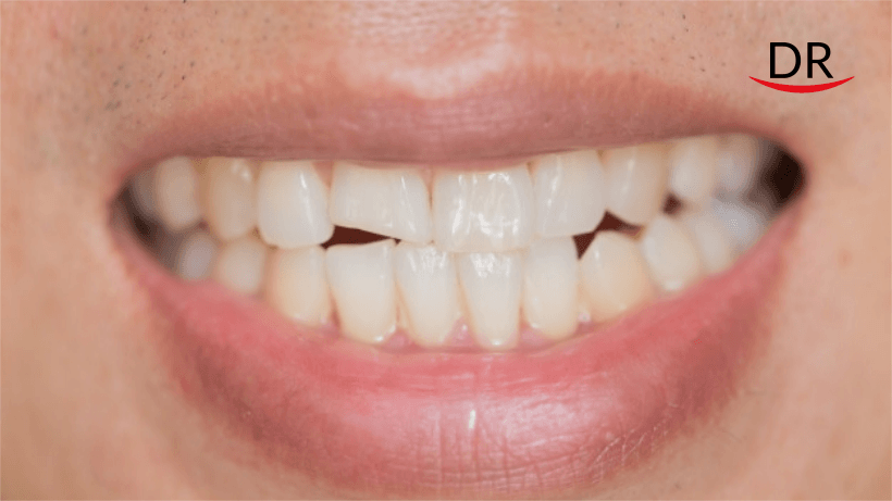 Reports of Cracked Teeth Uptick Amid COVID19