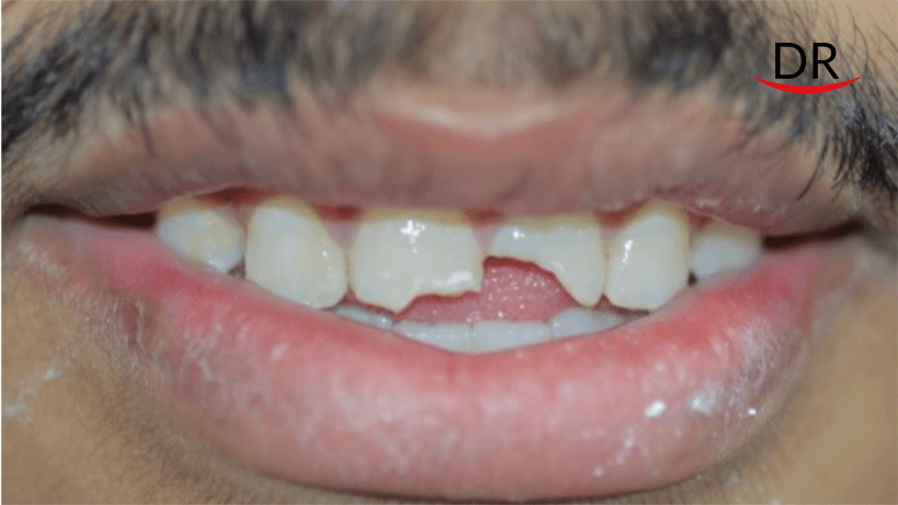 One Visit Endodontics with Esthetic Rehabilitation of Fractured Maxillary Incisor