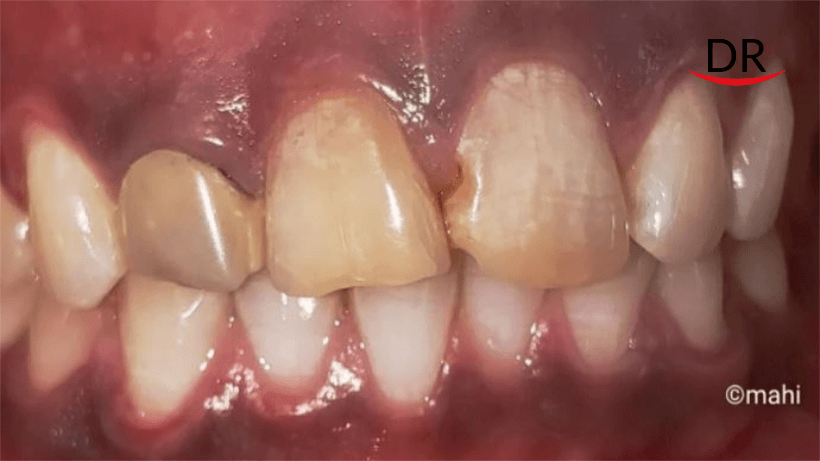 Esthetic make-over of maxillary anteriors with bleaching and layered zirconia crowns – A case report