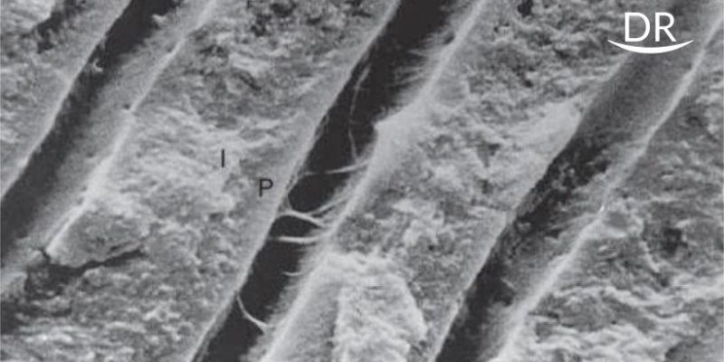 Continued Etching of Wet Dentinal Tubules by Single Bottle And Two Bottle Self Etch Adhesive-A Comparative In Vitro Study