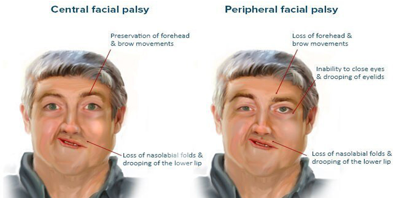 Bell’s Palsy & Covid-19 – does it ring a bell