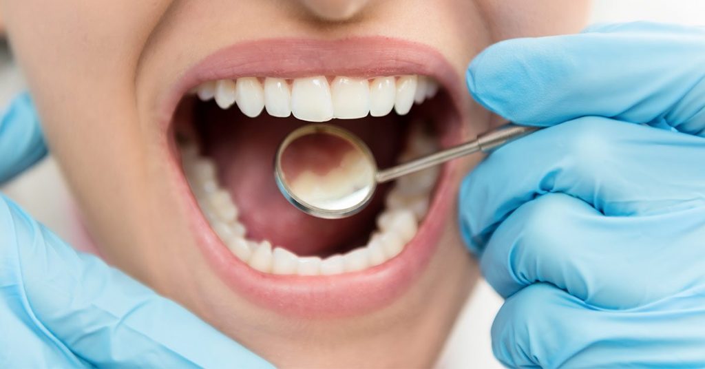 Effect Of Silver Diamine Fluoride On Tooth Hypersensitivity Among 20 to 60 Year Old Adults In Bangalore City: An invivo study