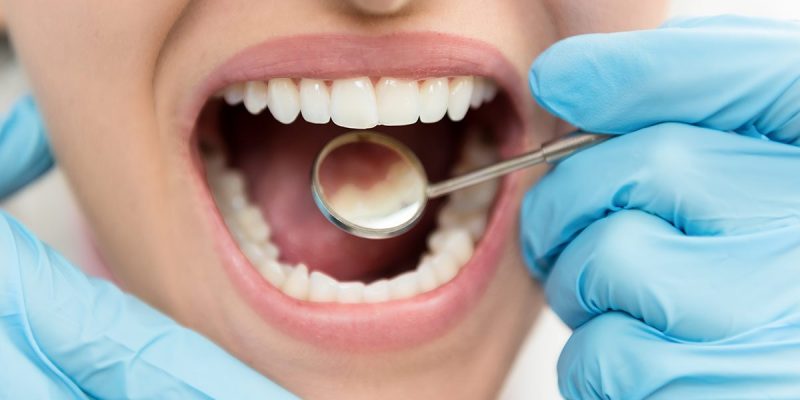 Effect Of Silver Diamine Fluoride On Tooth Hypersensitivity Among 20 to 60 Year Old Adults In Bangalore City: An invivo study