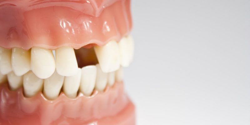 Non-traumatic tooth loss significantly increases the risk of cardiovascular disease-A study.
