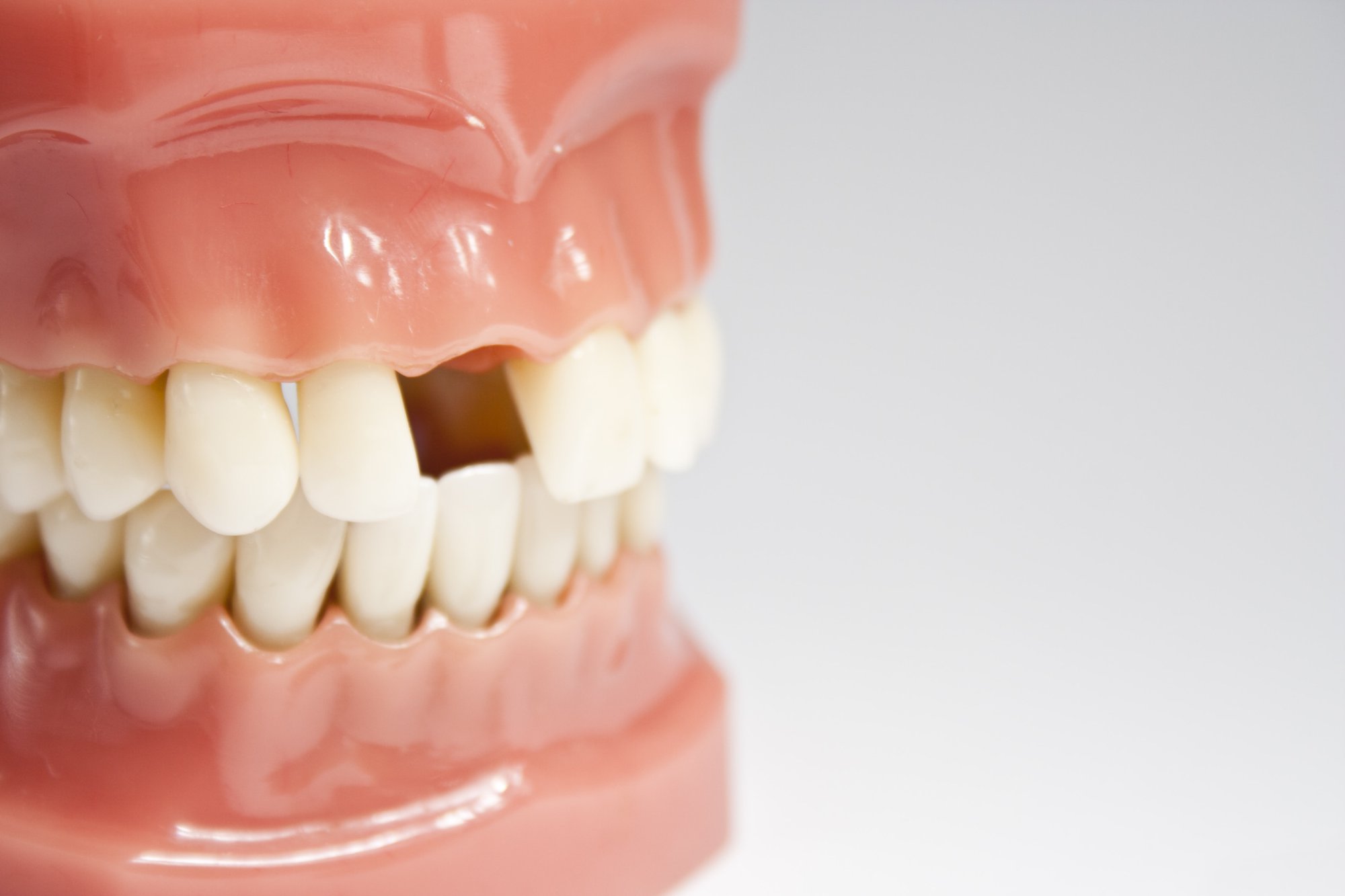 Non-traumatic tooth loss significantly increases the risk of cardiovascular disease-A study.