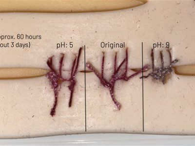 Sutures that could detect an infection-A breakthrough invention!