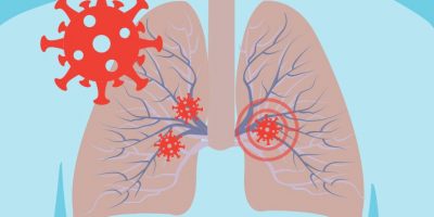 The Covid-19 Pathway: A proposed oral route to severe lung damage.