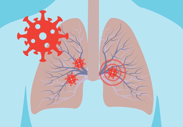 The Covid-19 Pathway: A proposed oral route to severe lung damage.