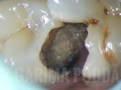 Root Canal Treatment Of Mandibular Second Premolar With 1-2 Configuration/ Type IV Weine’s Configuration- A Case Report