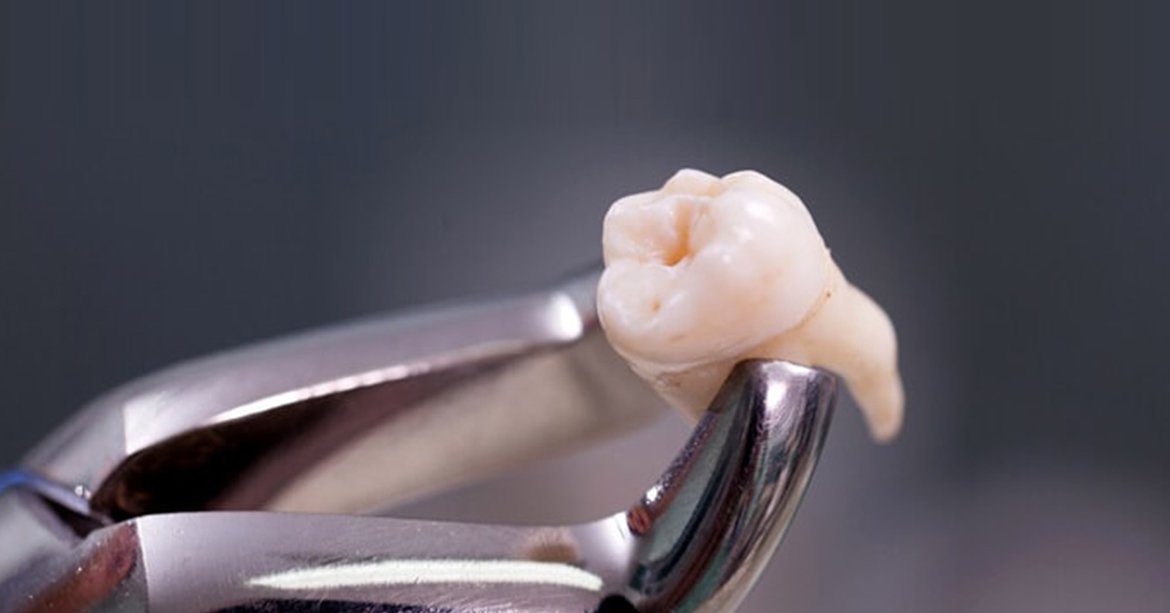 Wisdom Teeth Extraction Can Actually Improve Your Taste, Finds Study