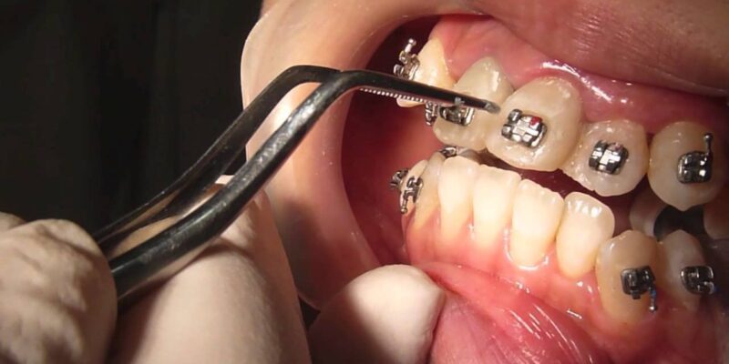 Orthodontics in Eluding Certain Systemic Diseases and Infections