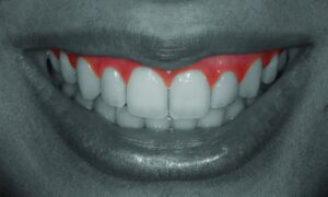 Gingival Zenith: A Collar To Be Proud About In Dentistry