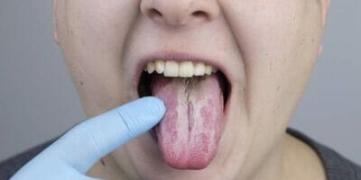 Covid-19 Signs & Symptoms in Oral & Maxillofacial Region