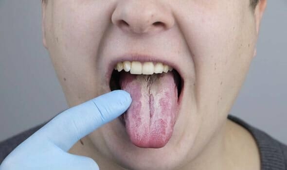 Covid-19 Signs & Symptoms in Oral & Maxillofacial Region