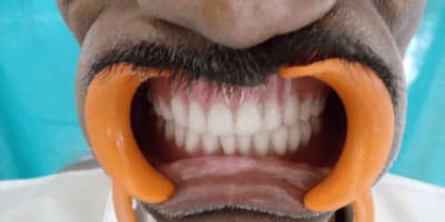 Impression Technique for a Patient with Maxillary Defect - A Case Report