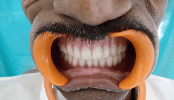 Impression Technique for a Patient with Maxillary Defect - A Case Report