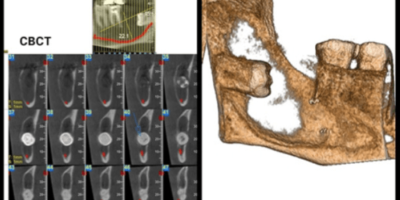 Surgical Management Of Mandibular Dentigerous Cyst – A Case Report