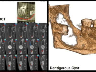 Surgical Management Of Mandibular Dentigerous Cyst – A Case Report