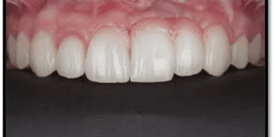 Soft Tissue Augmentation For Gingival Defect Using Connective Tissue Graft : A Case Report
