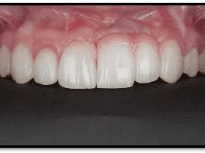Soft Tissue Augmentation For Gingival Defect Using Connective Tissue Graft : A Case Report