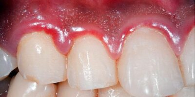 Antacids Found To Unexpectedly Reduce Gum Disease Severity-Study.