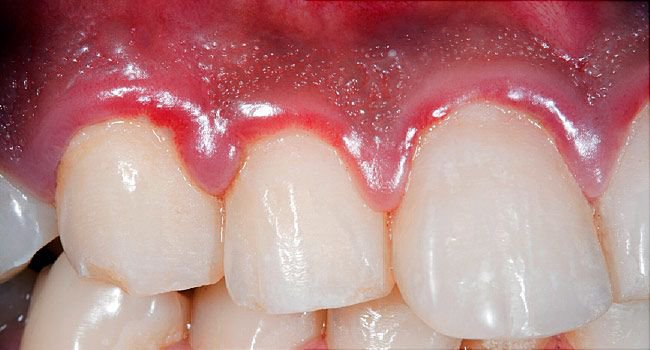 Antacids Found To Unexpectedly Reduce Gum Disease Severity-Study.