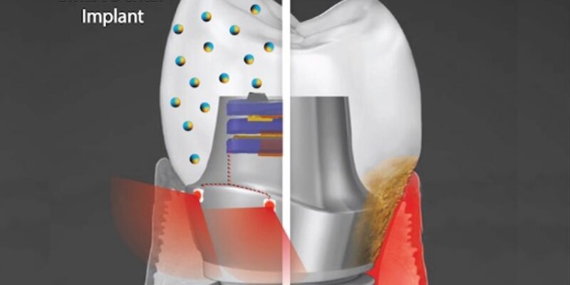 Smart Dental Implants To Resist Bacterial Growth By Generating Electricity