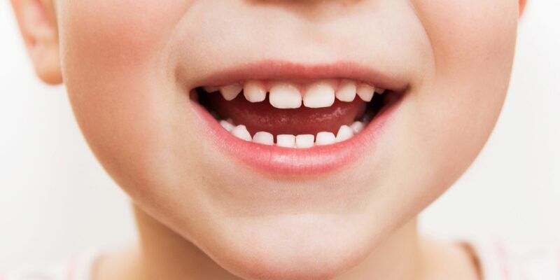 Deciduous Teeth May Help Identify Kids At Risk For Mental Disorders