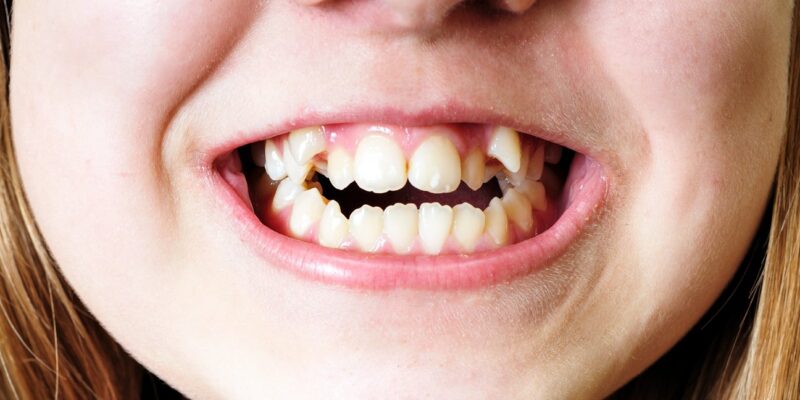 DIY Braces are Crooked for Your Teeth!