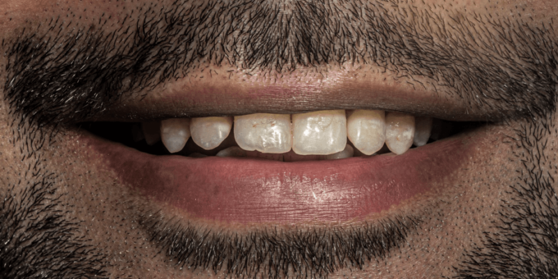 Biomimetic Rehabilitation of Multiple Teeth with Interdental Spacing