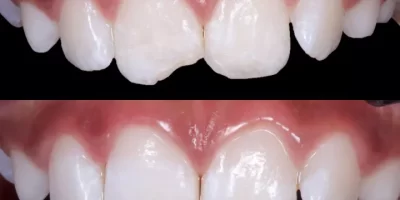Class 4 cavity restoration