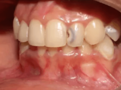 Management of deep Class III caries for a healthy and happy smile