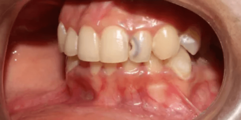 Management of deep Class III caries for a healthy and happy smile