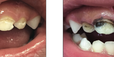 Silver Diamine Fluoride for Caries preventive dentistry in primary teeth cover