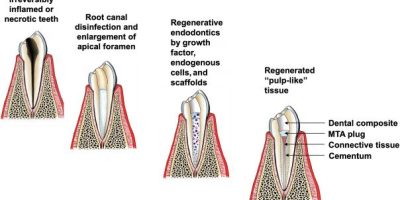 Cell Homing: A Game-Changer for Regenerative Endodontics? cover